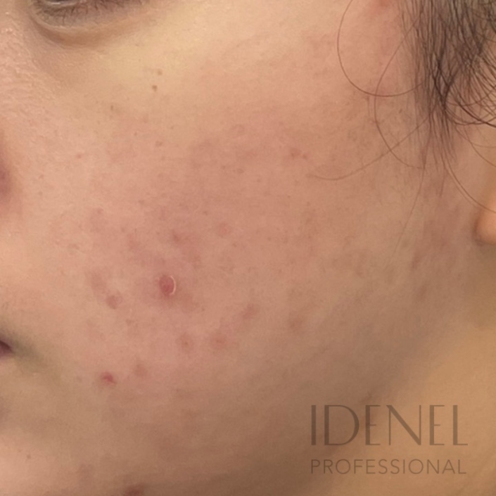 Después del tratamiento despigmentante y renovador para acné con peeling profesional en Barcelona