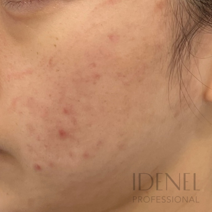 Antes del tratamiento despigmentante y renovador para acné con peeling profesional en Barcelona