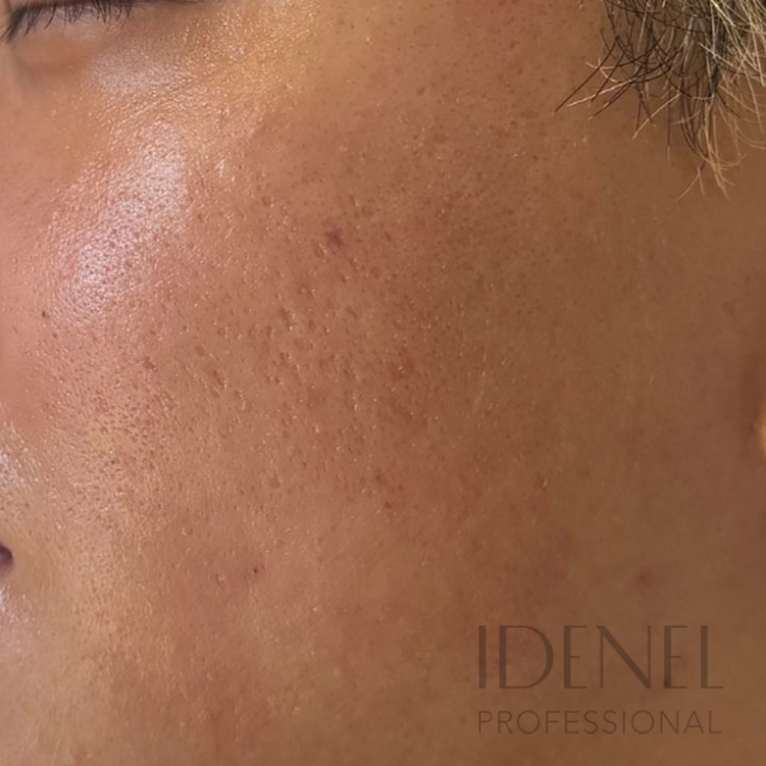 Después de peeling facial profesional en Barcelona con mejora visible de poros