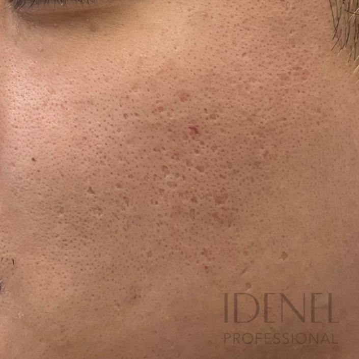 Antes de peeling facial profesional en Barcelona con poros visibles