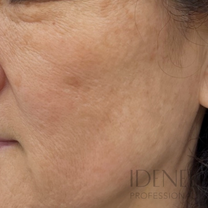 Después del Peeling Idenel personalizado para manchas en piel madura - resultados visibles