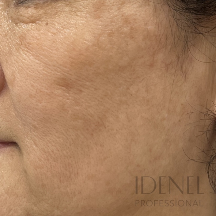 Antes del Peeling Idenel personalizado para manchas en piel madura